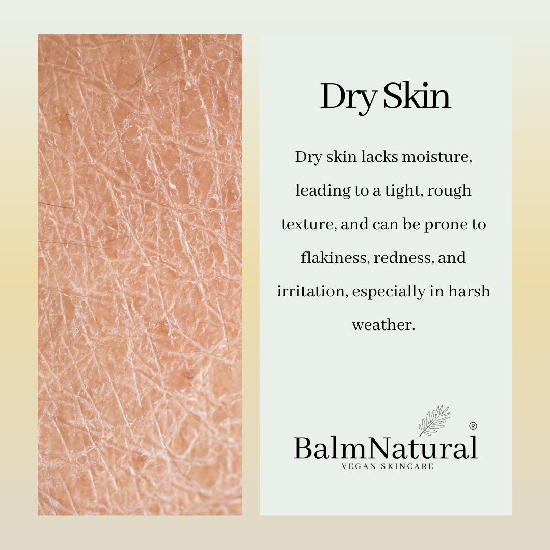 Looking After Dry Skin During Winter – BalmNatural