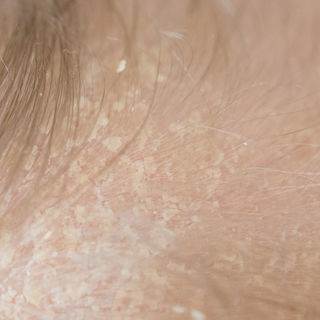 Image shows a baby's face with cradle cap, How to treat and remove cradle cap with BalmNatural baby balm